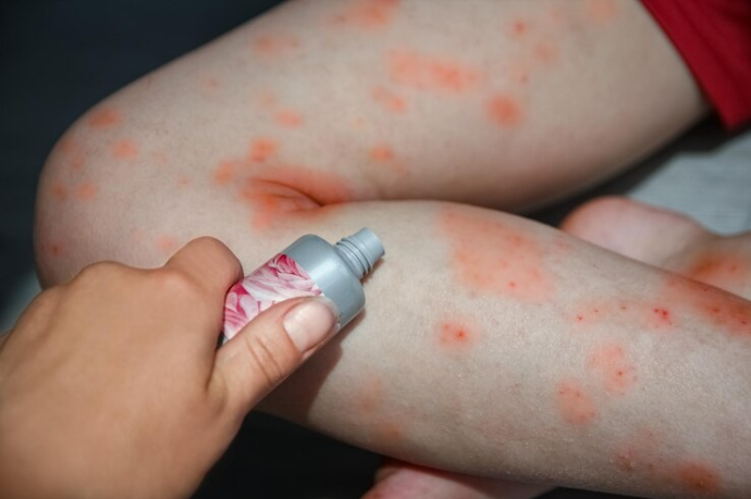 RESEP HERBAL HNI HPAI Kenali Ruam Kulit - Penyebab, Gejala, dan Cara Mengobatinya