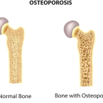 Osteoporosis: Penyebab, Gejala, dan Cara Mengobatinya