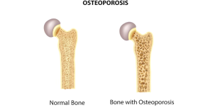 RESEP HERBAL HNI HPAI Osteoporosis: Penyebab, Gejala, dan Cara Mengobatinya