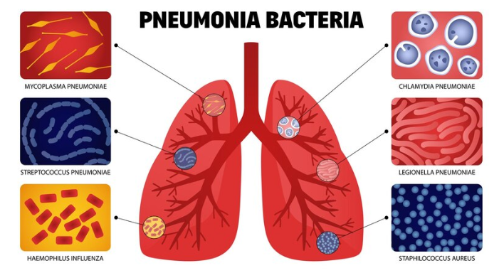 RESEP HERBAL HNI HPAI Pneumonia - Gejala, Penyebab, dan Pengobatan