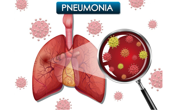 RESEP HERBAL HNI HPAI Pneumonia (Radang Paru-Paru) - Gejala dan Cara Mengobatinya