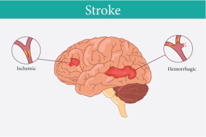 RESEP HERBAL HNI HPAI Stroke - Gejala, Penyebab, dan Pengobatan