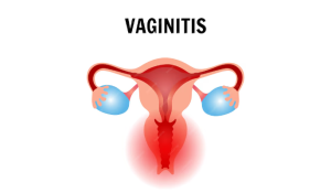 RESEP HERBAL HNI HPAI Vaginitis - Gejala, Penyebab, dan Pengobatan