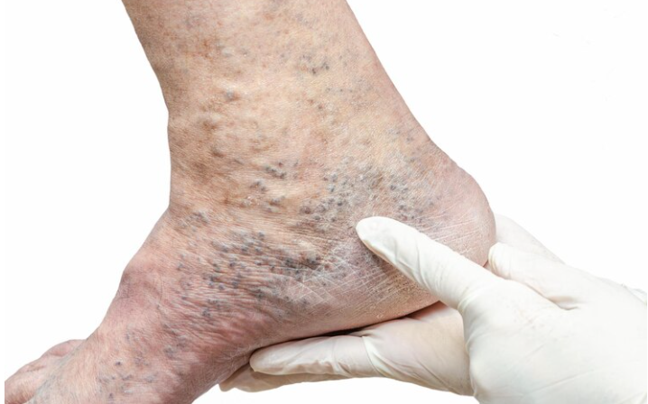 RESEP HERBAL HNI HPAI Varises pada Kaki - Gejala, Penyebab, dan Pengobatannya
