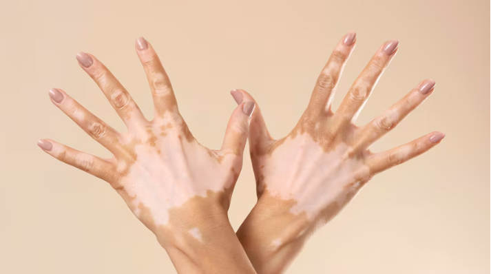 RESP HERBAL HNI HPAI Vitiligo - Gejala, Penyebab, dan Pengobatan