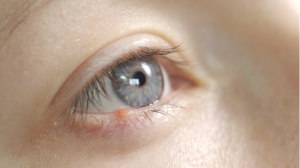 RESEP HERBAL HNI HPAI Xanthelasma, Penyebab dan Pengobatan