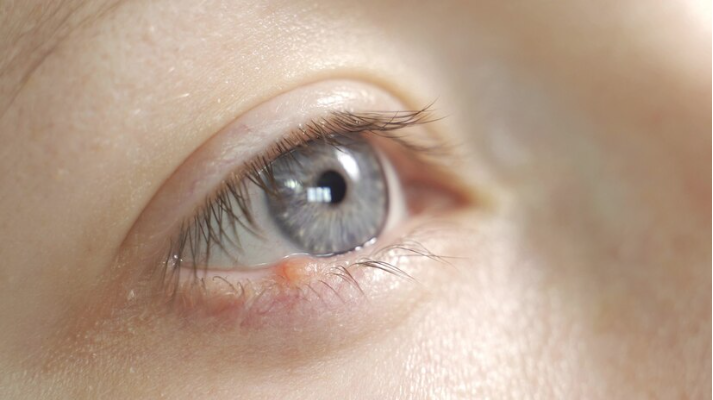 RESEP HERBAL HNI HPAI Xanthelasma, Penyebab dan Pengobatan