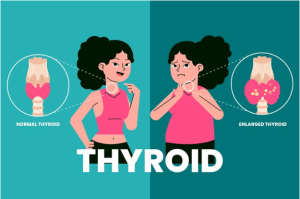 Resep Herbal Alami HNI HPAI Gejala Gondok - Tiroid Pada Leher