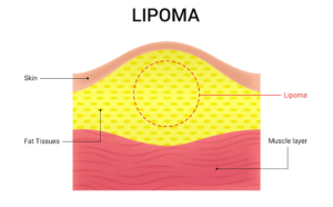 Tumor Jinak Dibawah Kulit Lipoma
