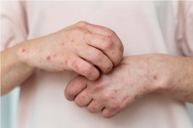 Resep Herbal HNI HPAI Apa itu Autoimun Kronis Lupus