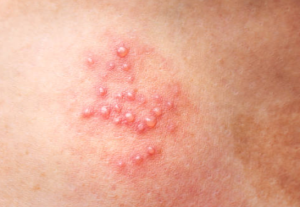 Resep Herbal HNI HPAI Apa itu Herpes Gejala, Penyebab & Pengobatannya