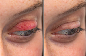 Resep Herbal HNI HPAI Blepharitis Radang Kelopak Mata Gejala & Penyebabnya