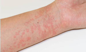 Resep Herbal HNI HPAI Dermatitis Kontak Gejala Penyebab Pencegahannya