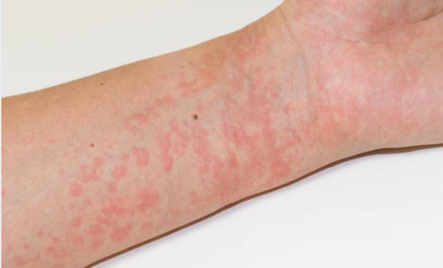 Resep Herbal HNI HPAI Dermatitis Kontak Gejala Penyebab Pencegahannya