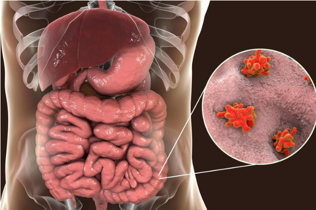 Resep Herbal HNI HPAI Disentri atau Radang Usus Berdarah