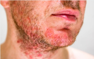 Resep Herbal HNI HPAI Dermatitis Seboroik Kenali Ruam Kulit dan Bercak Merah